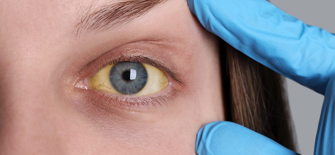 Hepatitis Unveiled Types of Hepatitis and their causes